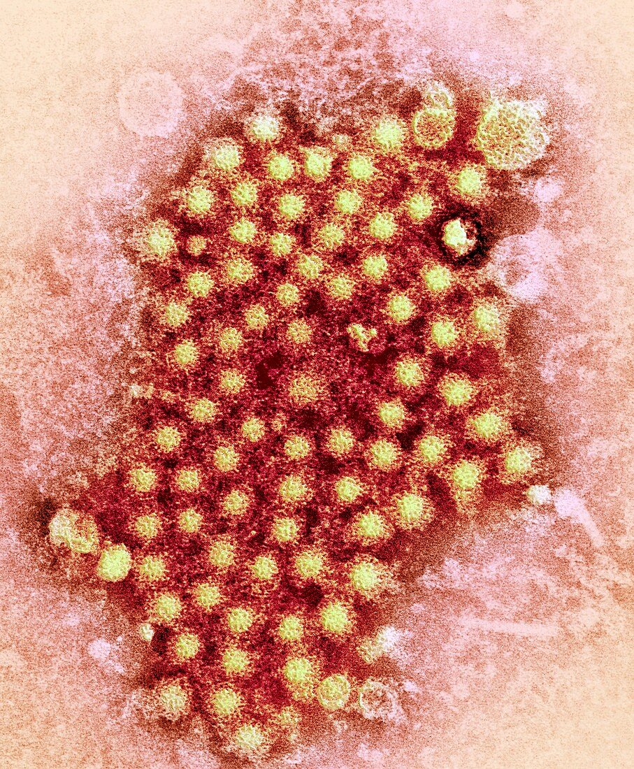 Hepatitis virus particles,TEM