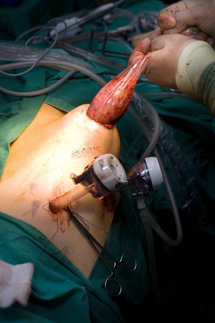 Kidney surgery