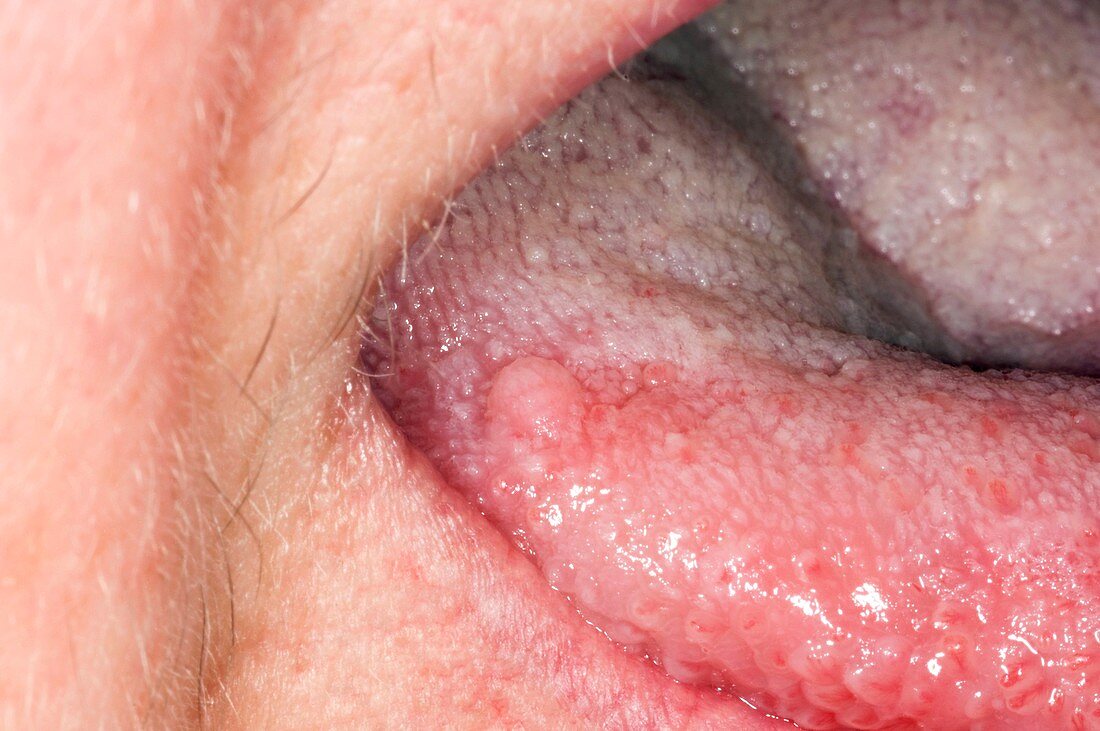 Squamous cell papilloma on tongue