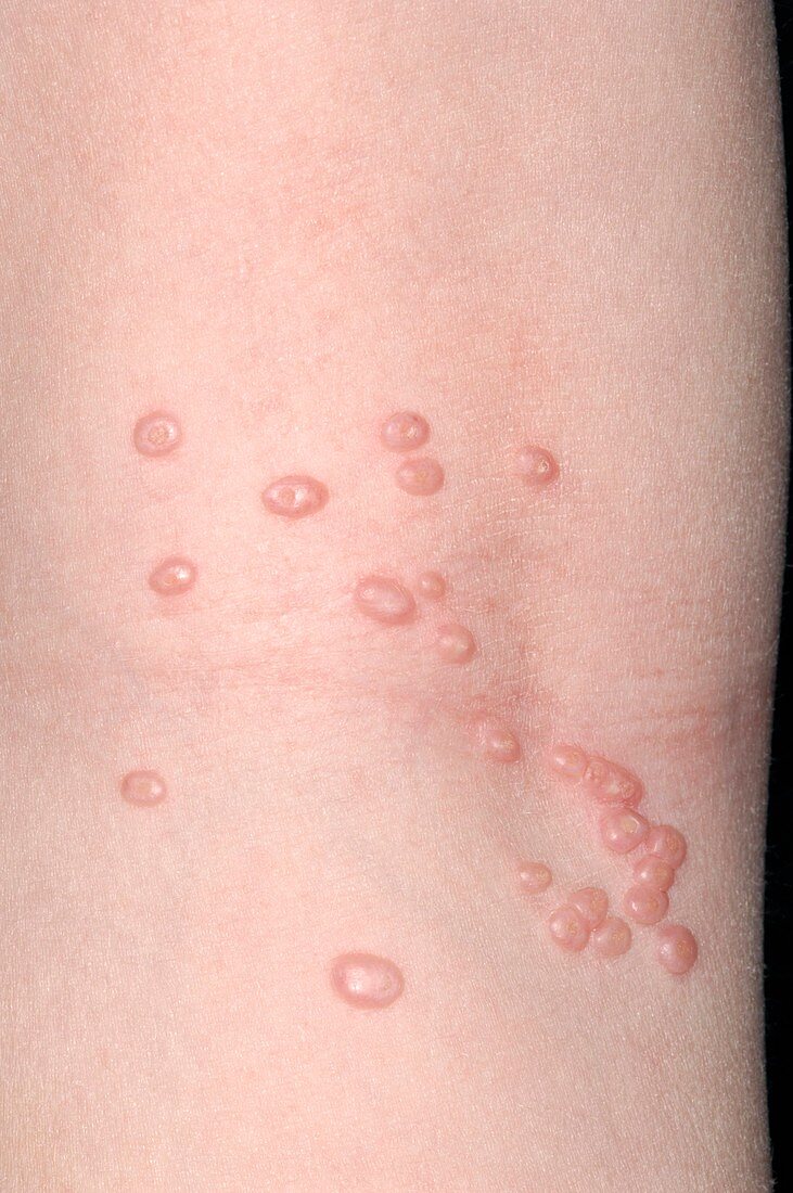 Molluscum contagiosum skin infection