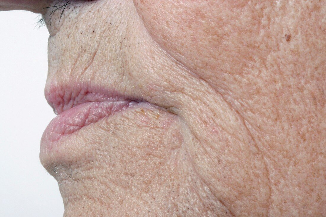 Elderly person's mouth