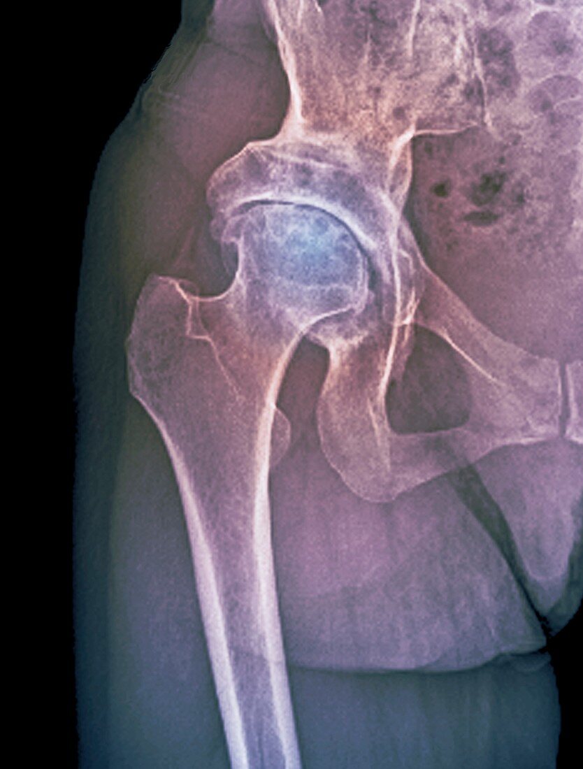 X-ray of hip with osteoarthritis