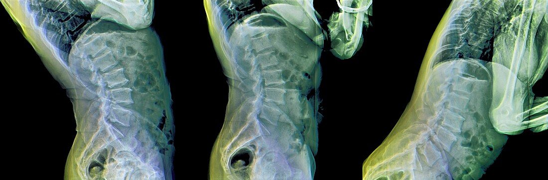 X-rays of spinal movement