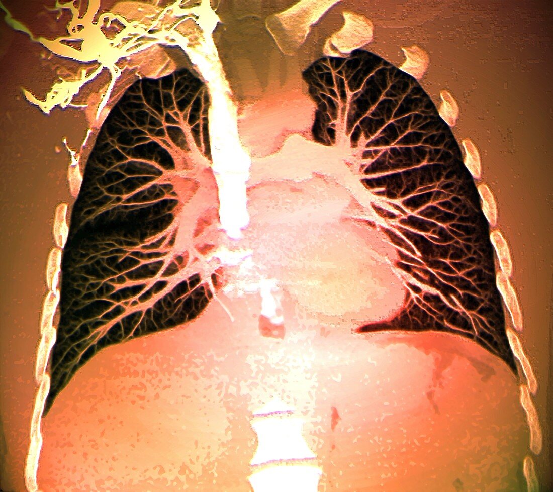 Blood vessels of healthy lungs