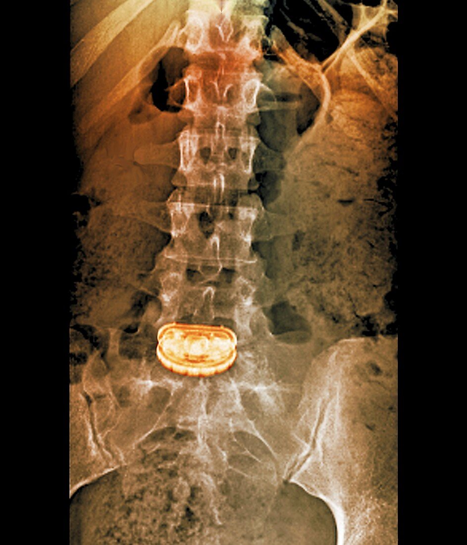 'Artificial spinal disc,X-ray'