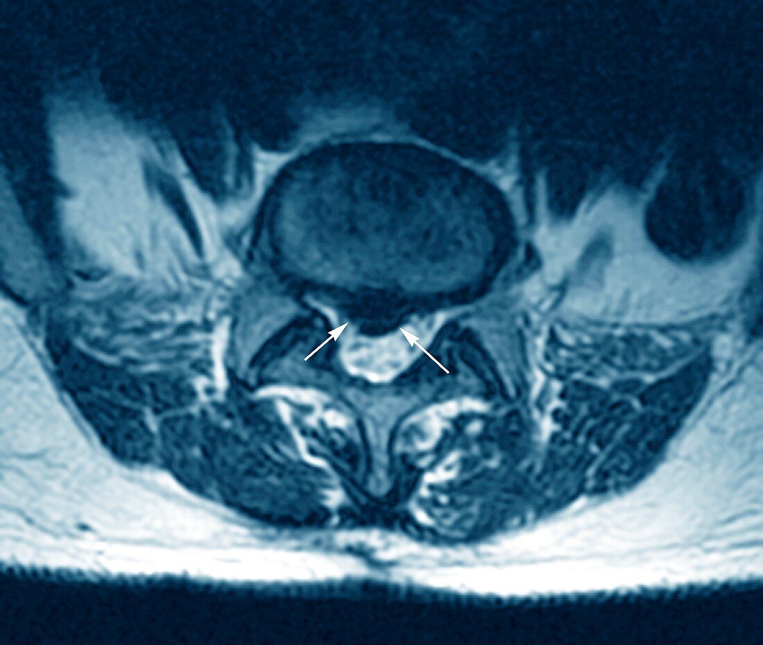 'Herniated spinal disc,MRI scan'