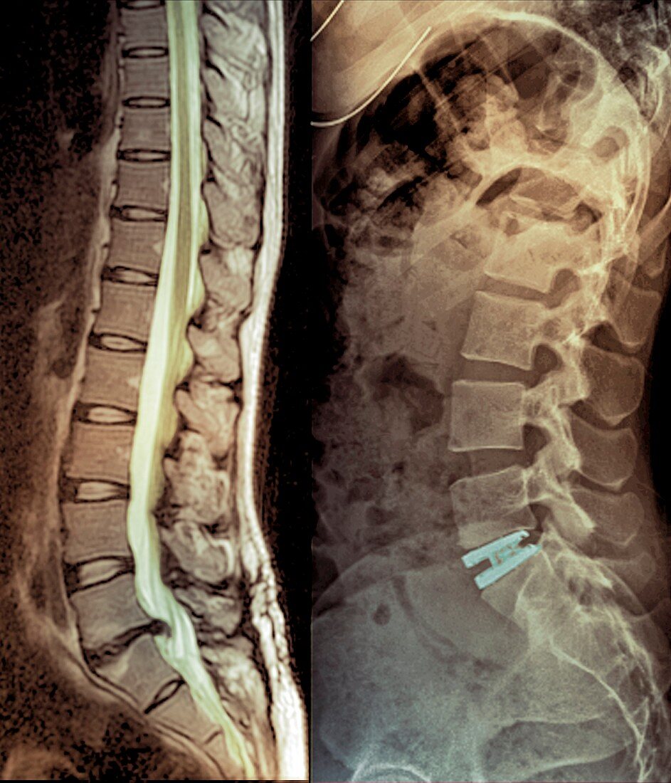 Spinal disc hernia and prosthesis