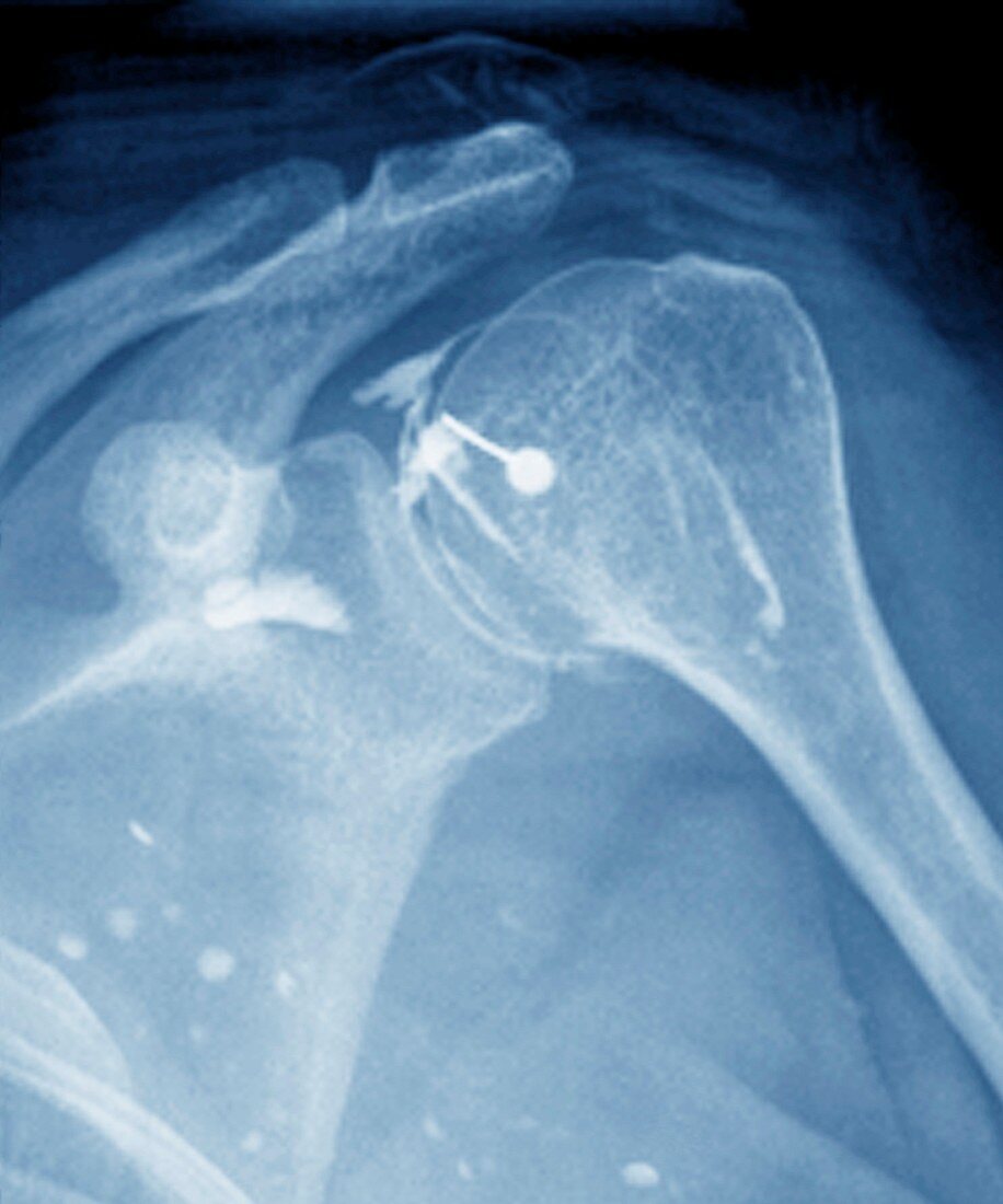Steroid treatment of shoulder joint