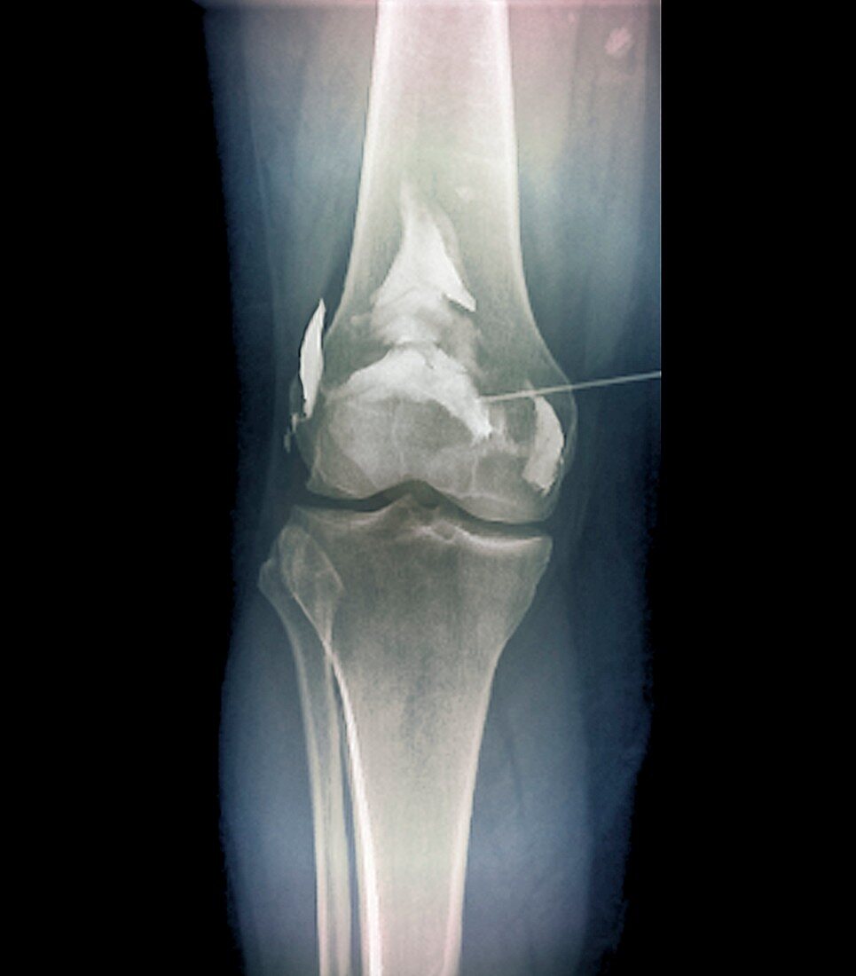 Treatment of knee osteoarthritis
