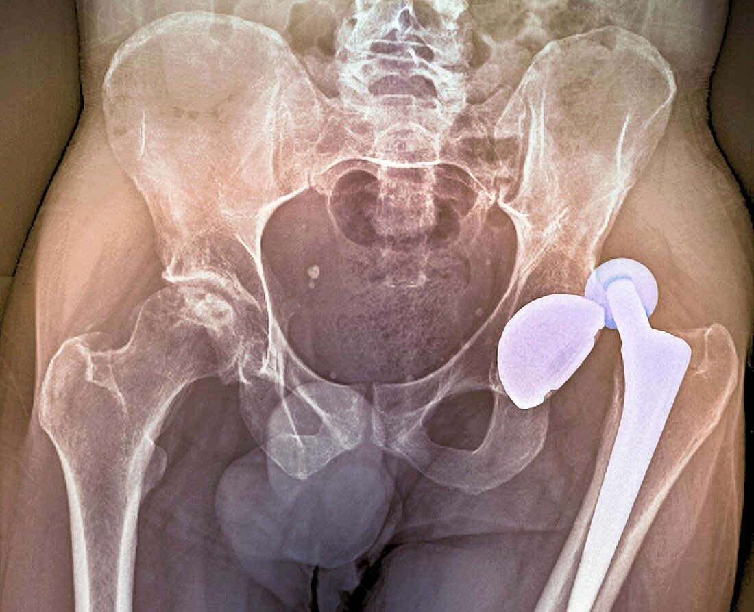'Dislocated hip replacement,X-ray'