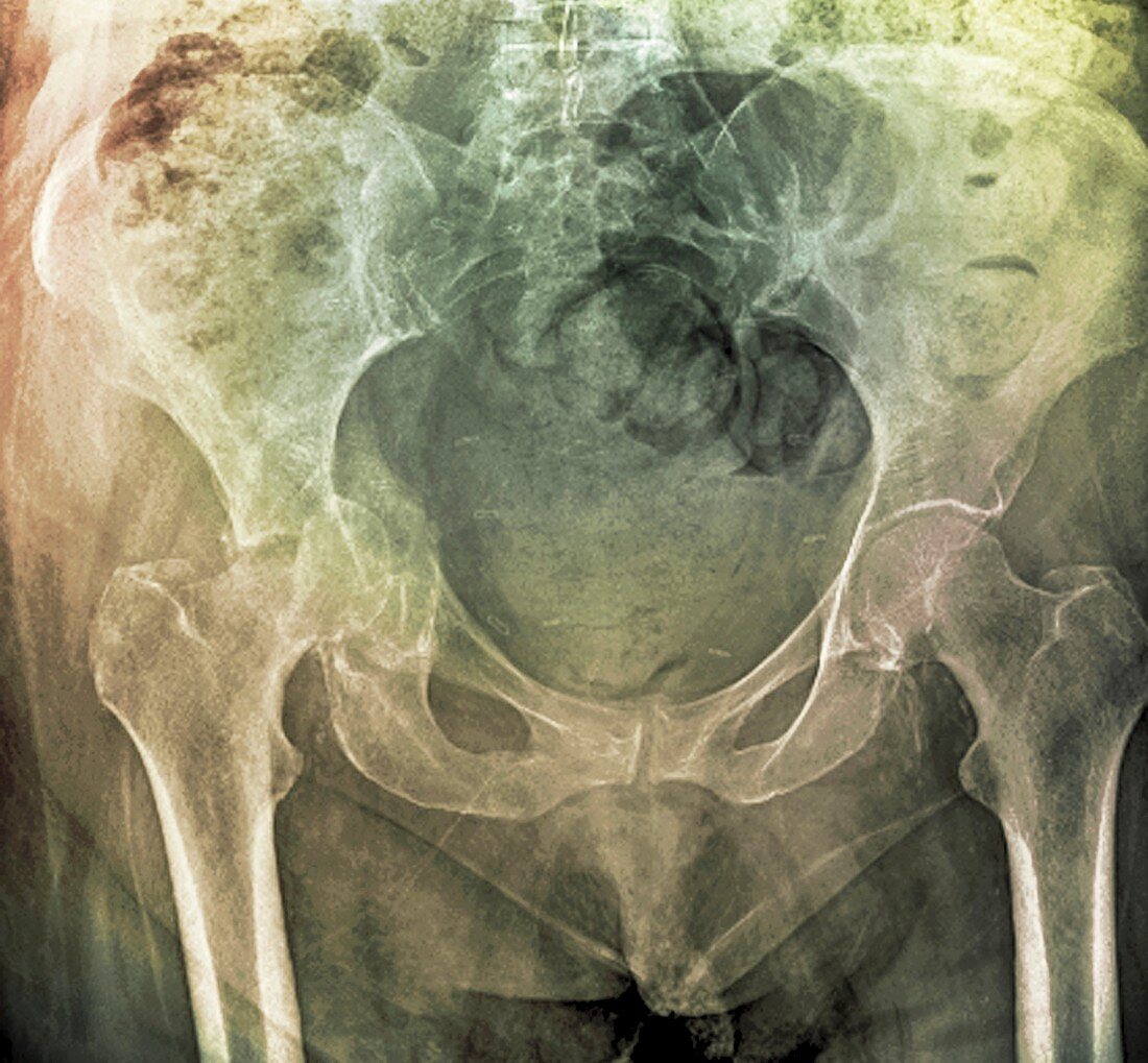 'Pelvic fracture,X-ray'