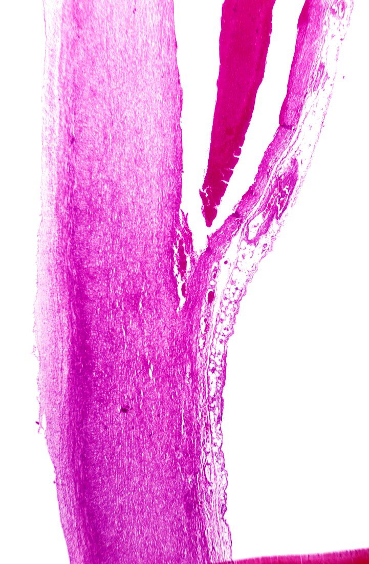 Dissecting aorta,light micrograph