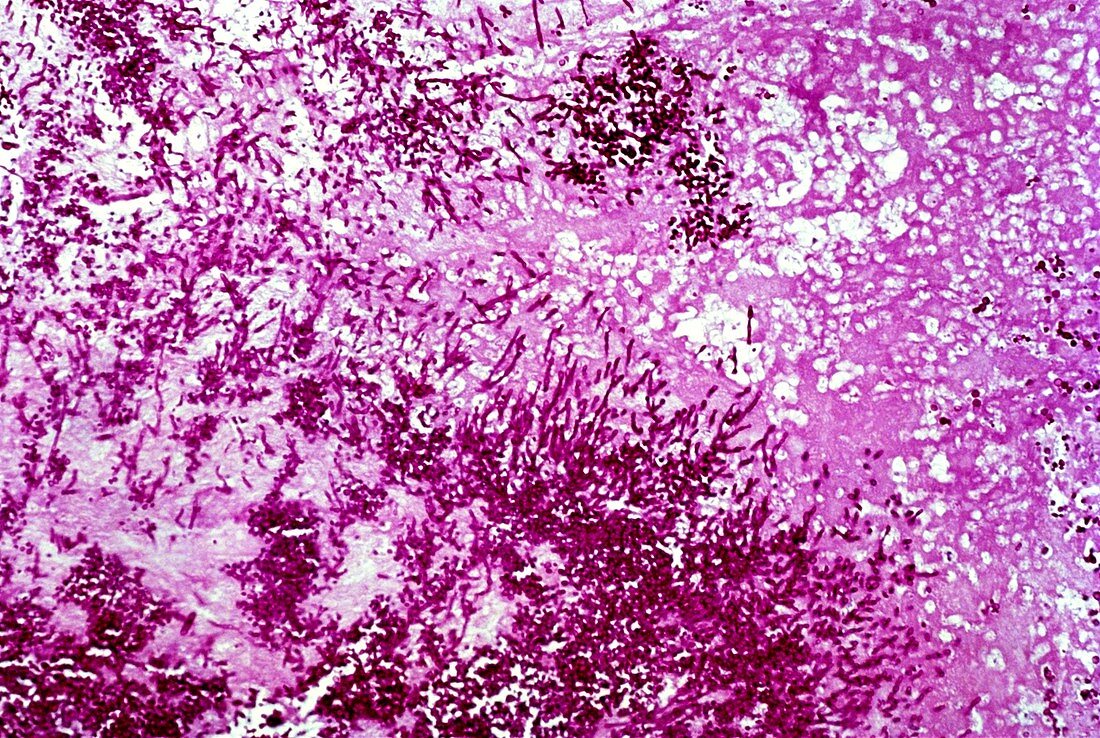 Fungal heart infection,light micrograph
