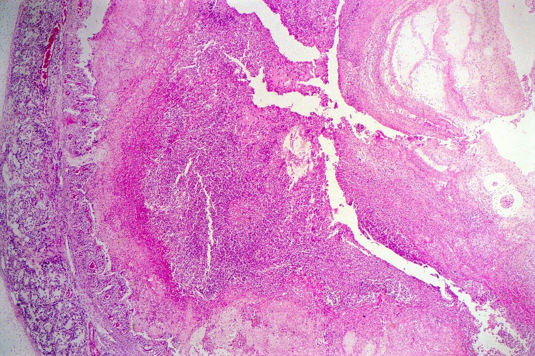 Throat cancer,light micrograph