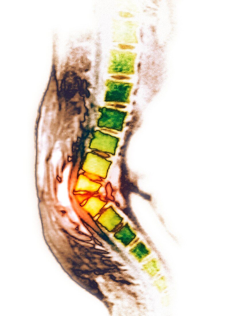 'Kyphosis of the spine,CT scan'