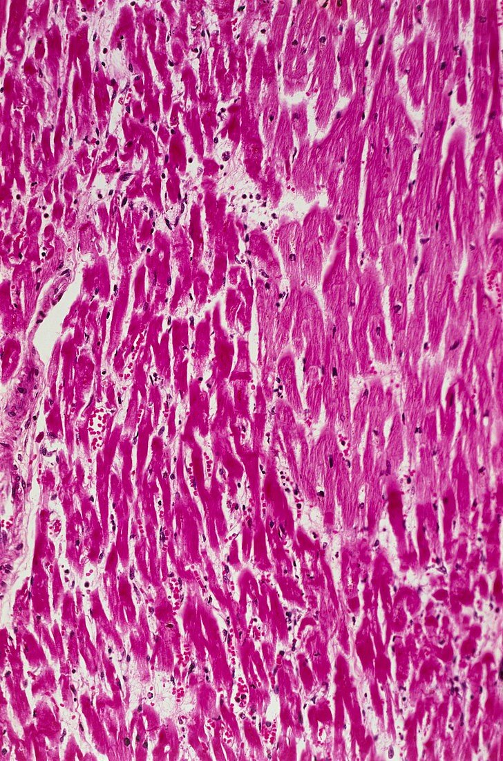 Heart tissue death,light micrograph