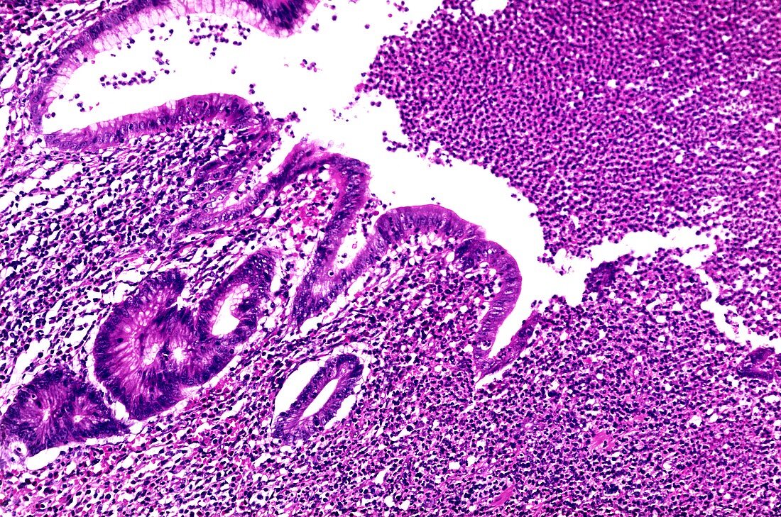 Acute appendicitis,light micrograph