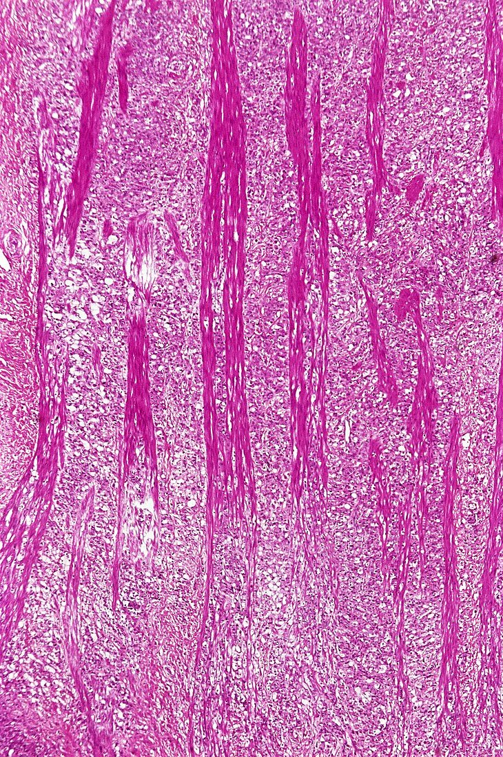 Stomach cancer,light micrograph