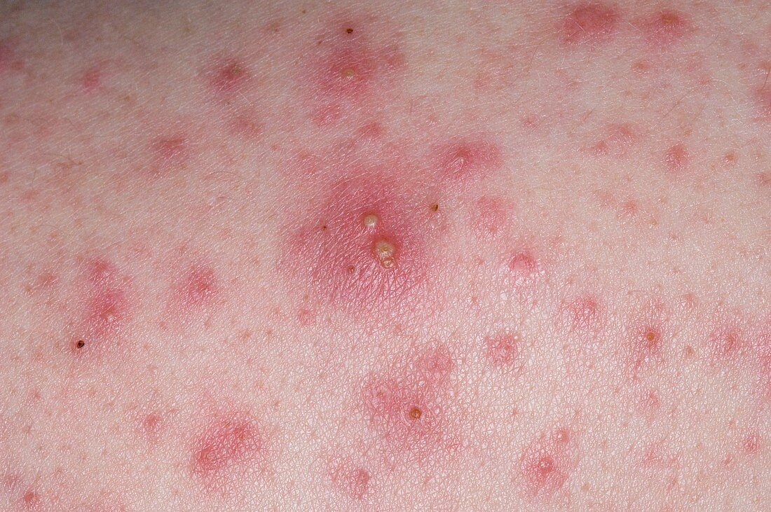 Close-up of acne vulgaris