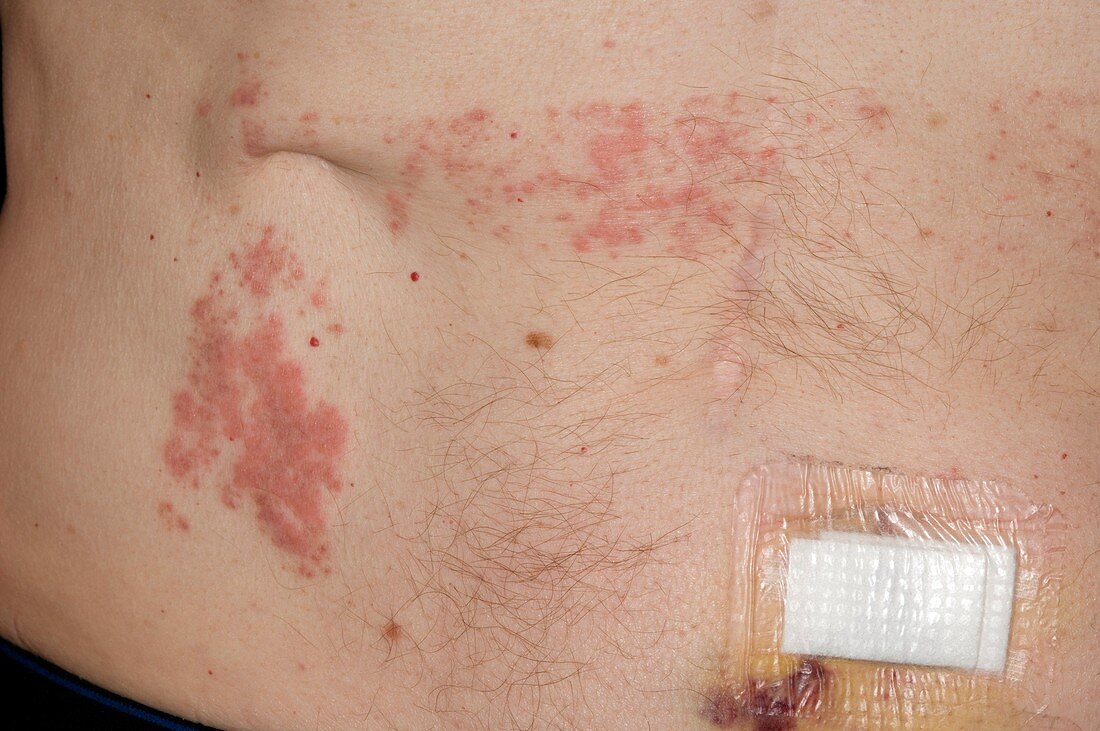 Allergic skin reaction to adhesive