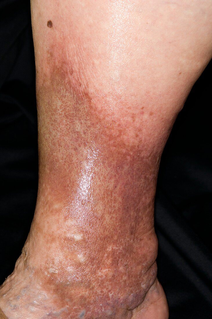 Pigmentation and varicose eczema