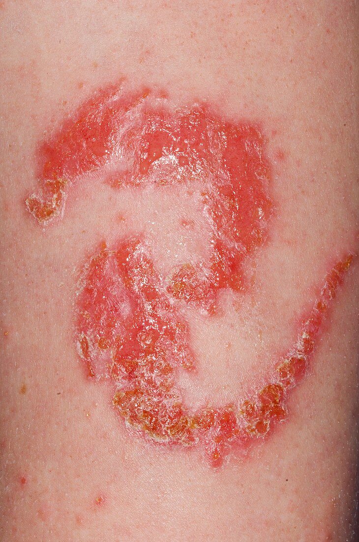 Allergic skin reaction to tattoo