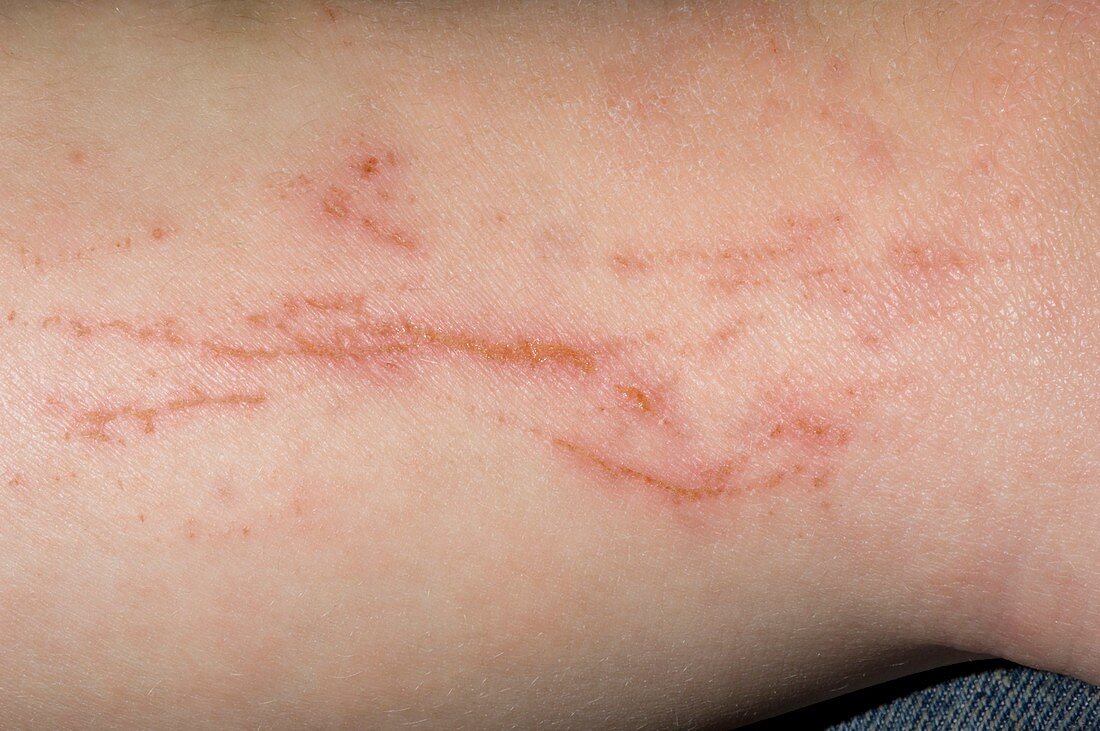 Atopic eczema with scratch marks
