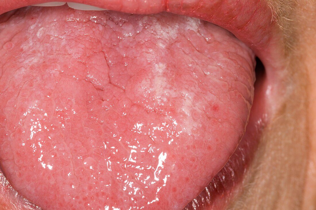 Candida infection of the tongue