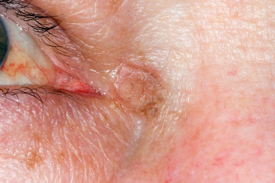 Actinic keratosis near the eye