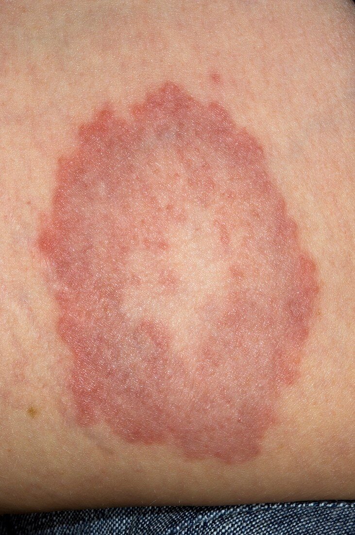 Granuloma annulare on the skin