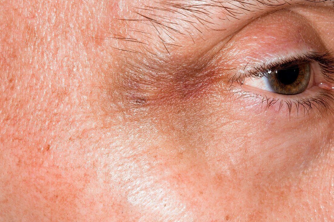Bruise at the corner of the eye