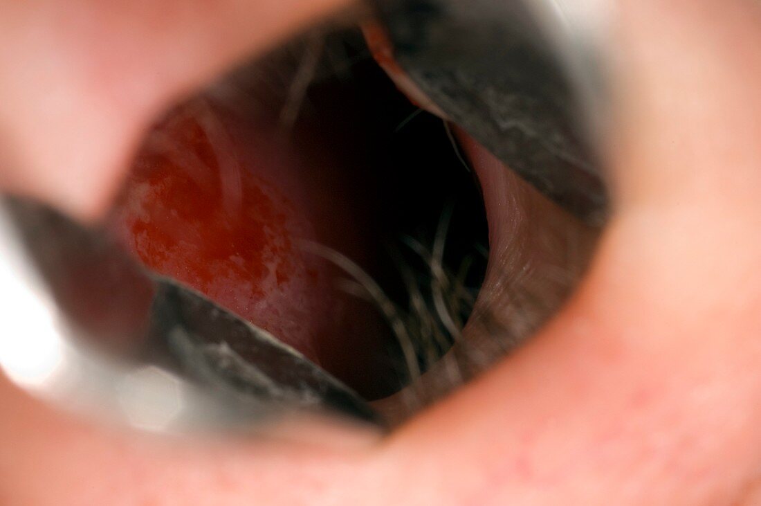 Inflamed mucosa in the nose