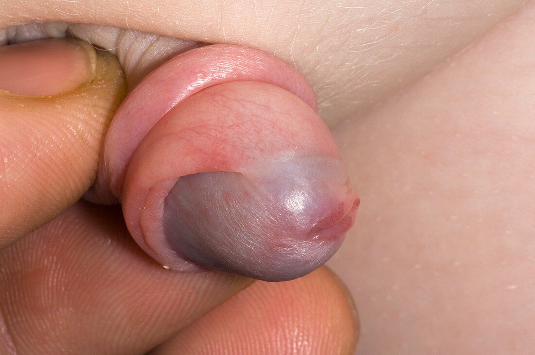 Foreskin adhesions on the penis