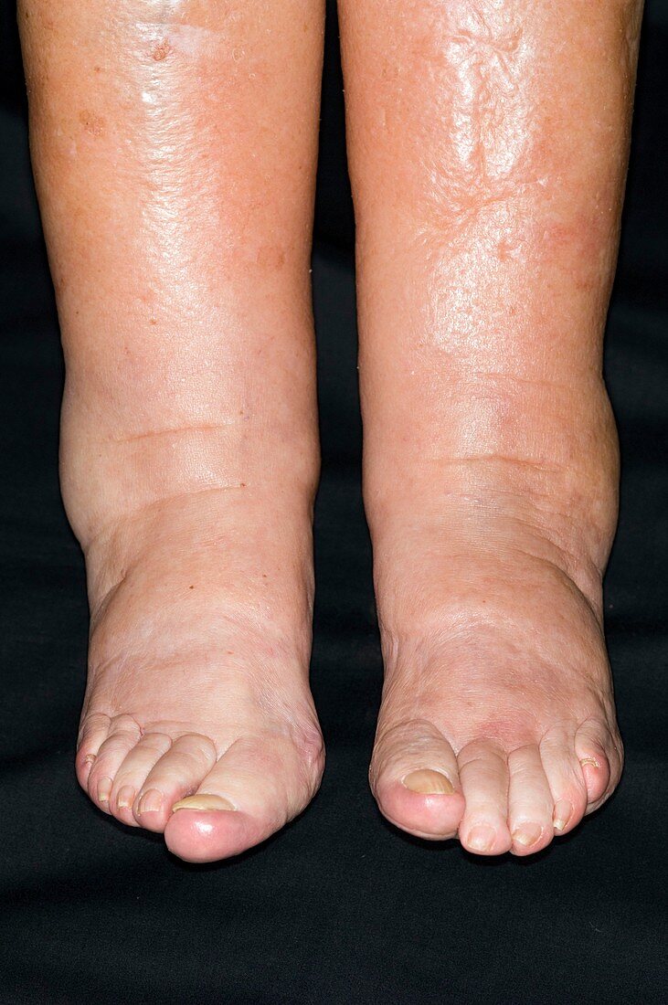 Ankle oedema in heart failure