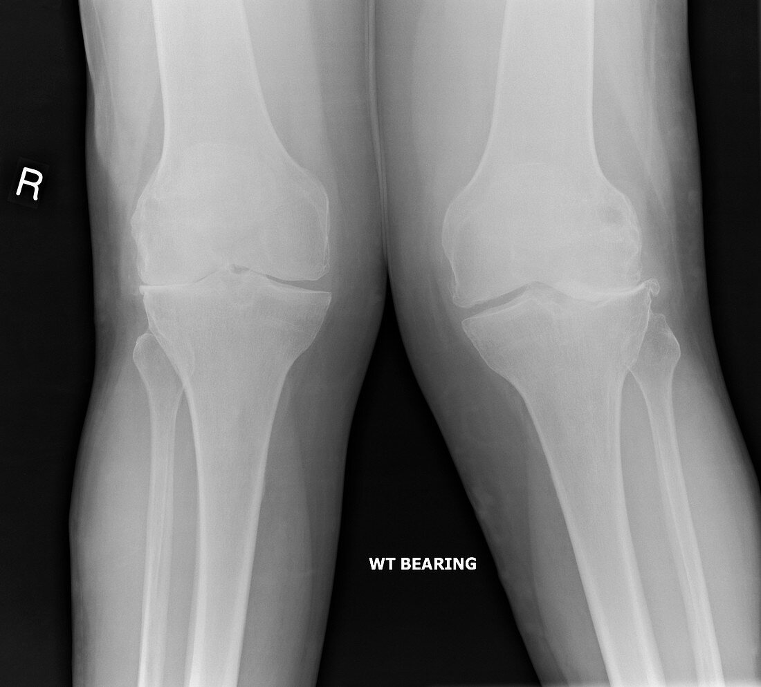 'Osteoarthritis of the knees,X-ray'