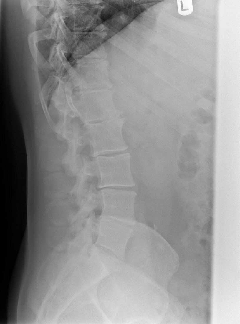 'Osteoarthritis of the spine,X-ray'