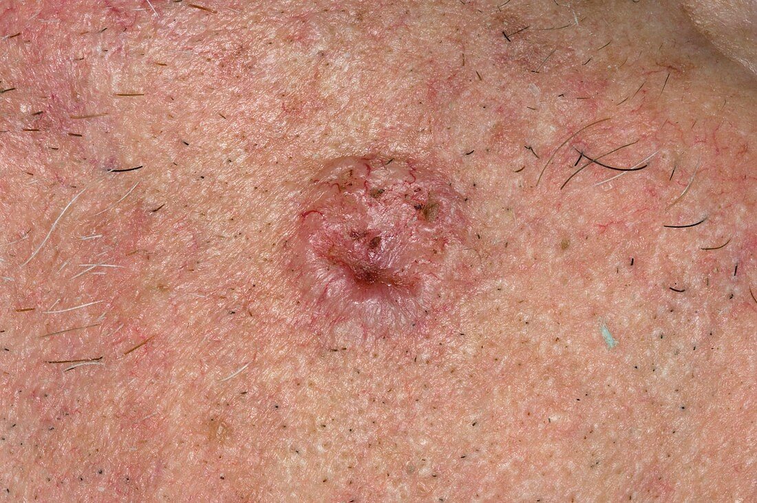 Basal cell carcinoma on the face