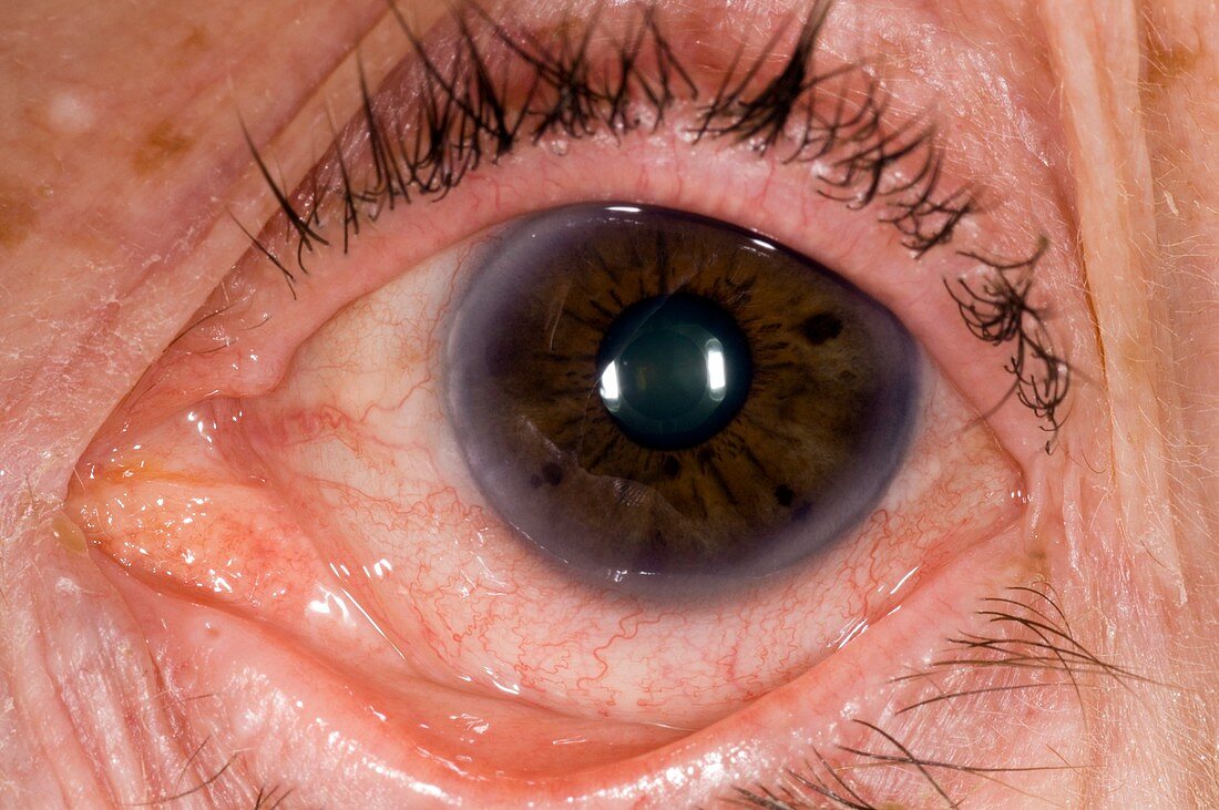 Viral conjunctivitis of the eye