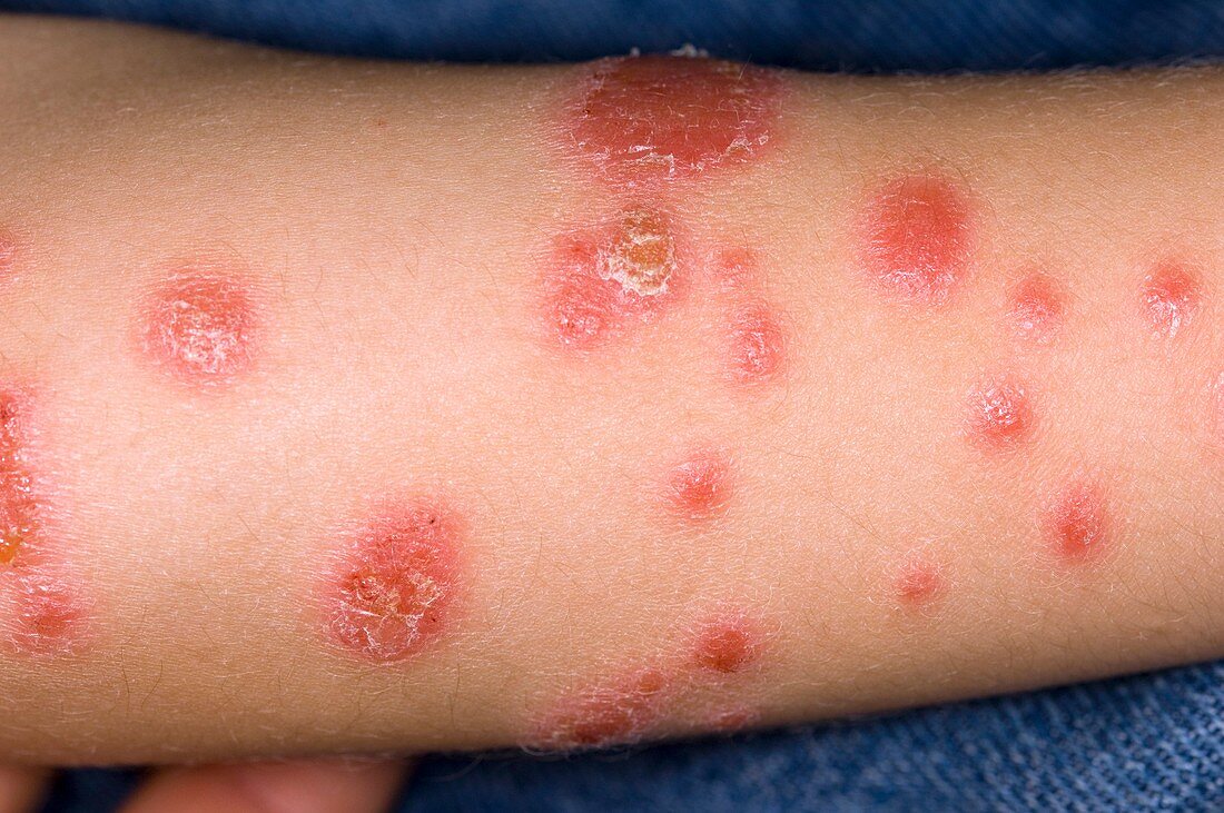 Psoriasis on the arm