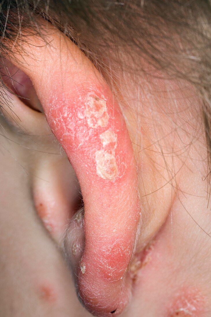 Psoriasis on the ear