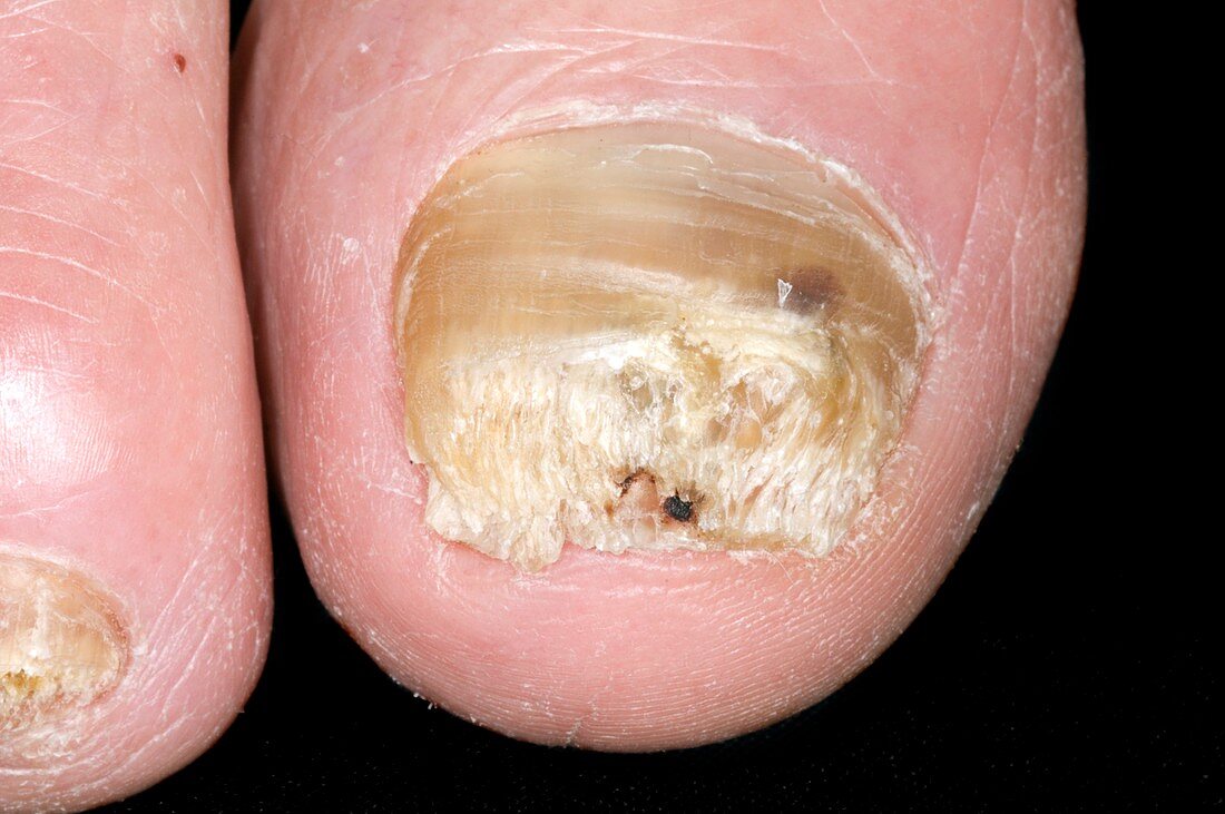 Psoriasis of the toe nails