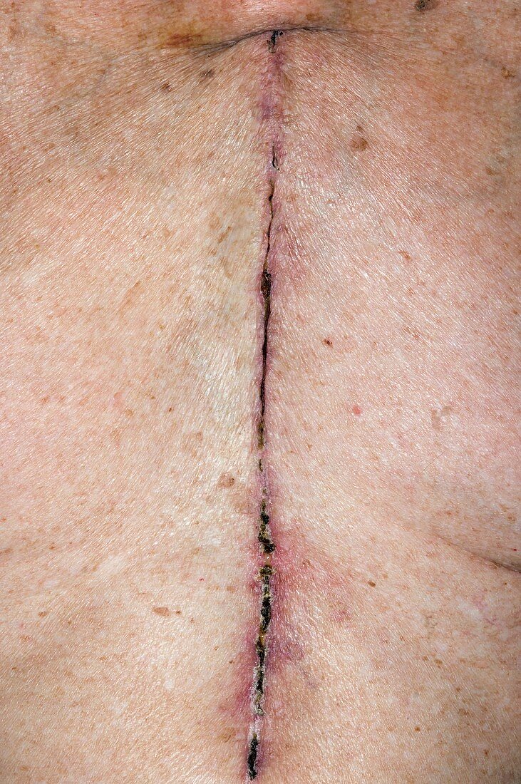 Chest scar after heart surgery