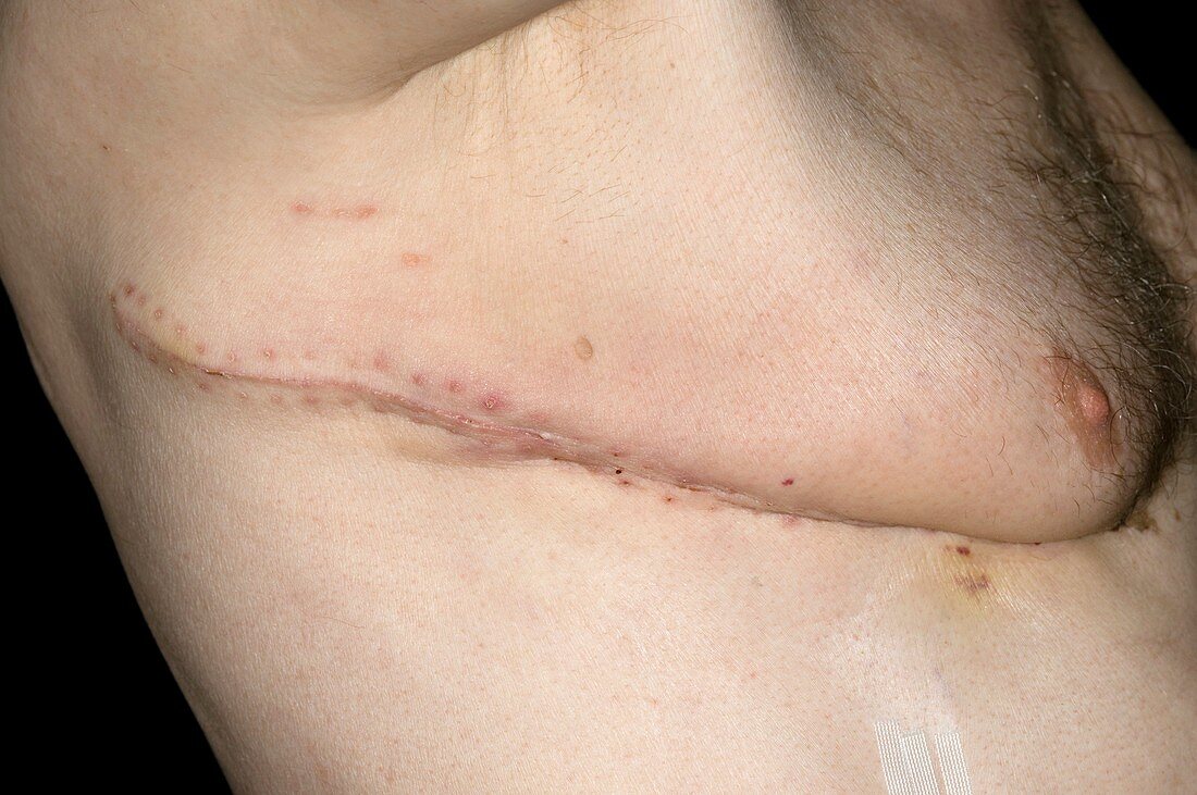 Chest scar for lung cancer