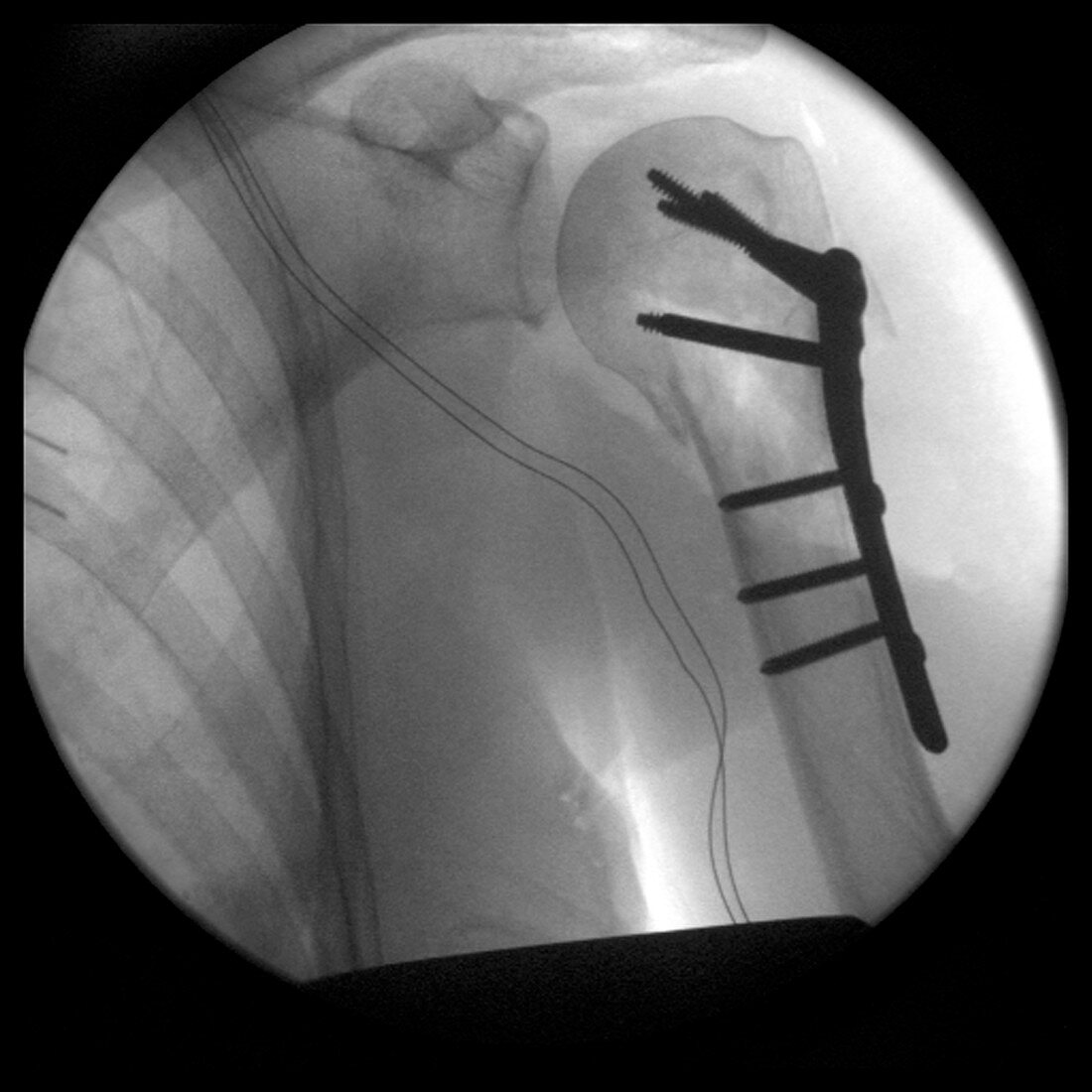 Pinned fracture of arm image 2 of 7