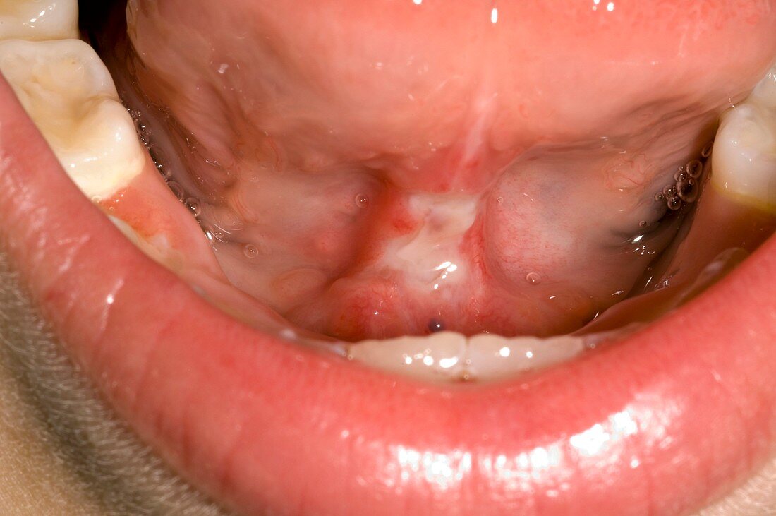 Treated tongue-tie (image 2 of 2)