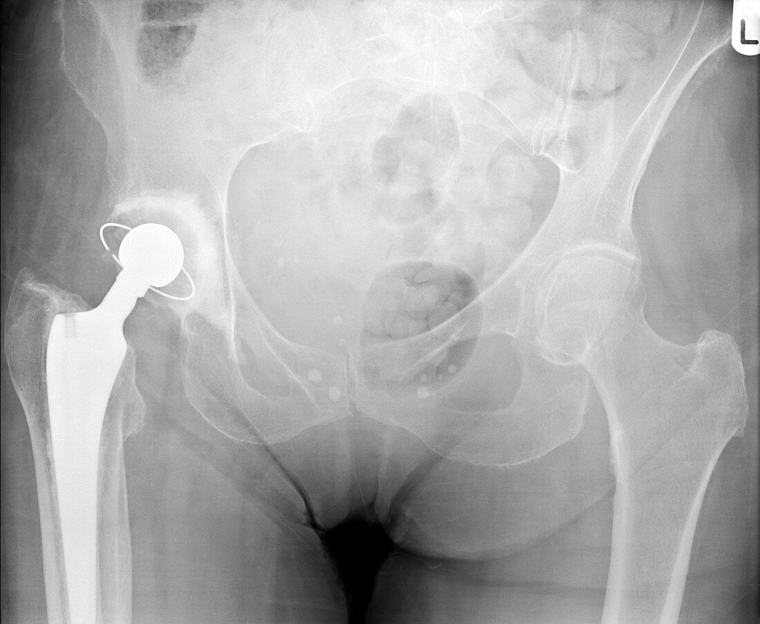 'Hip joint replacement,X-ray'