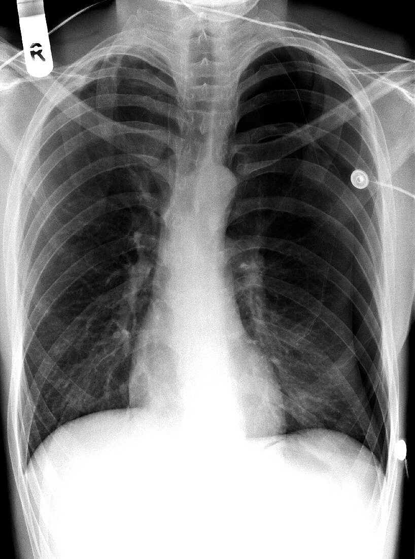'Pneumothorax,X-ray'