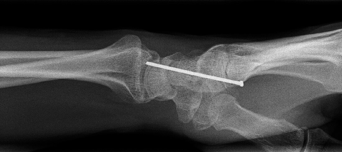 'Nail penetrating the wrist,X-ray'