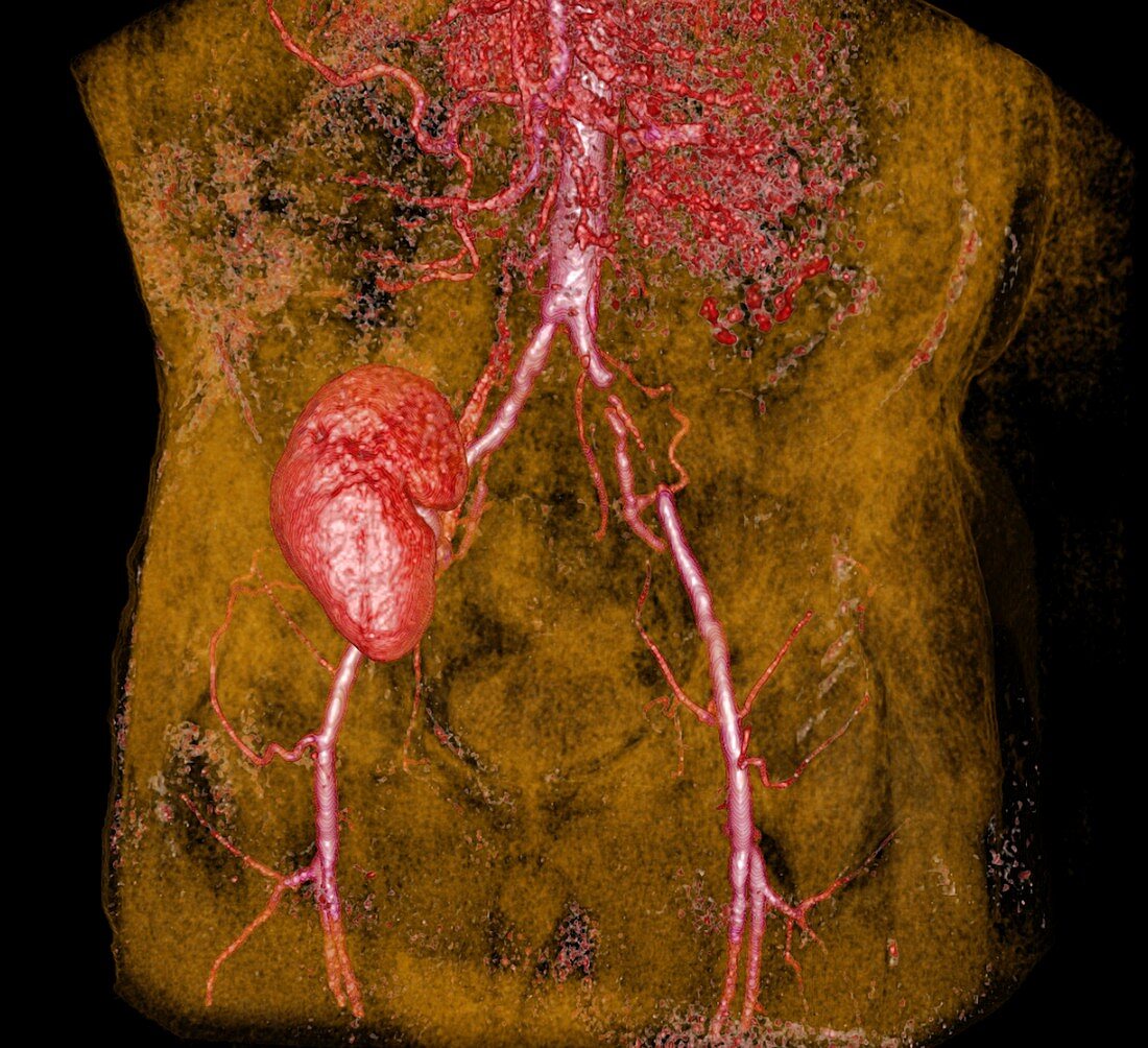 Iliac artery stenosis,3-D MRI scan