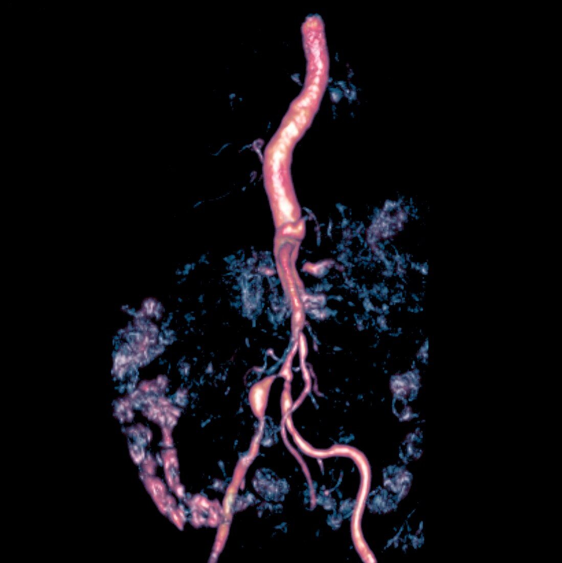'Bilateral renal artery stenosis,MRA sca